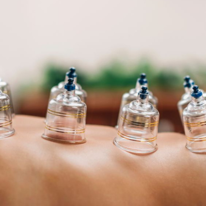 Cupping