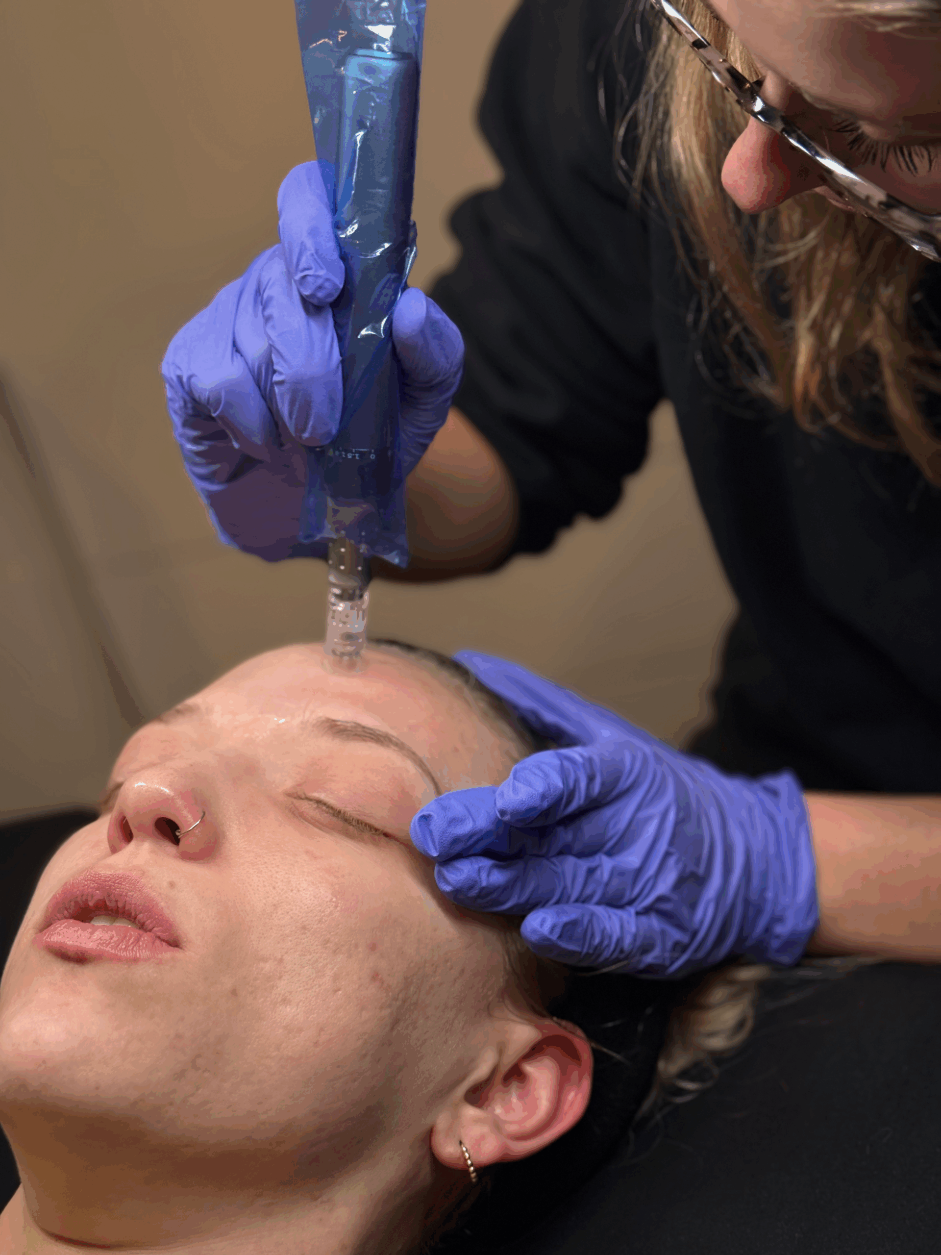 Microneedling